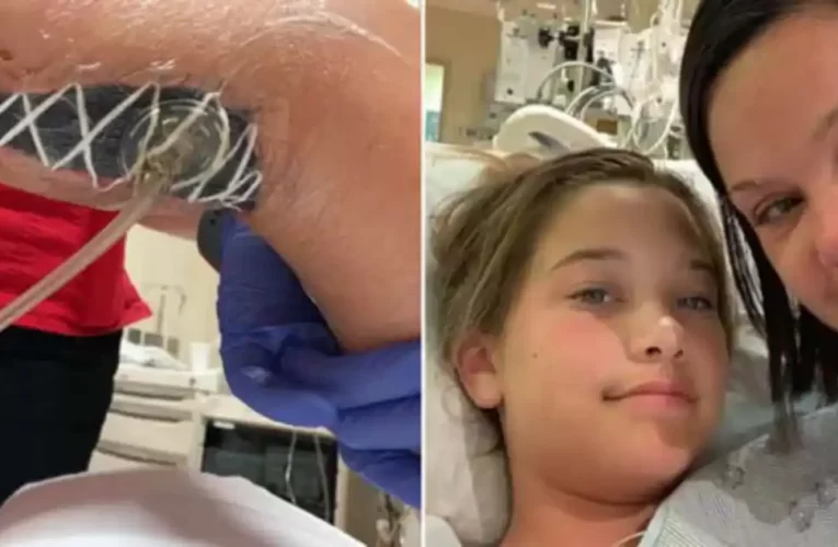 Su hija contrajo un virus come carne por una picadura