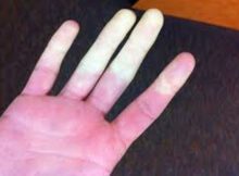 Raynaud: los cambios de color en los dedos son síntomas 0