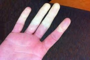 Raynaud: los cambios de color en los dedos son síntomas 0