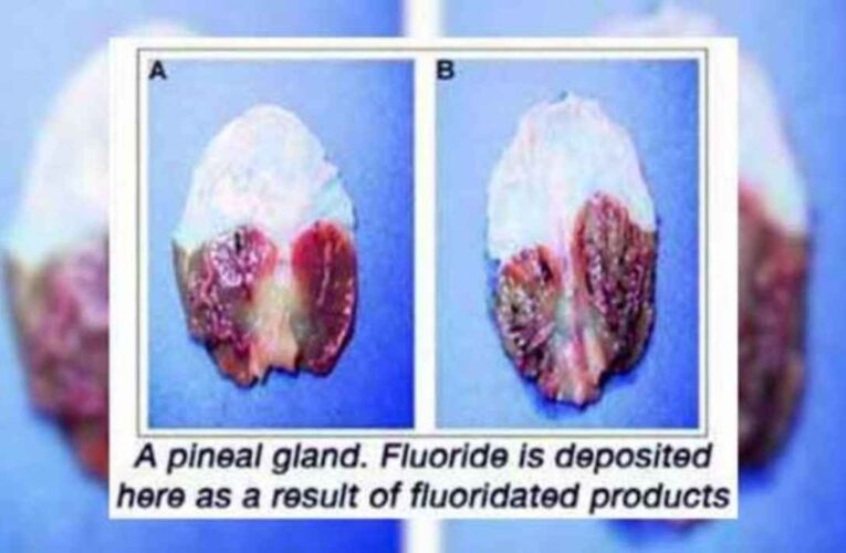 El consumo de flúor está asociado con la rápida calcificación de la glándula pineal en el cerebro