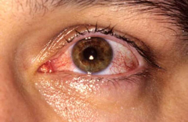 Conjuntivitis vista en casos de coronavirus sintomáticos y asintomáticos