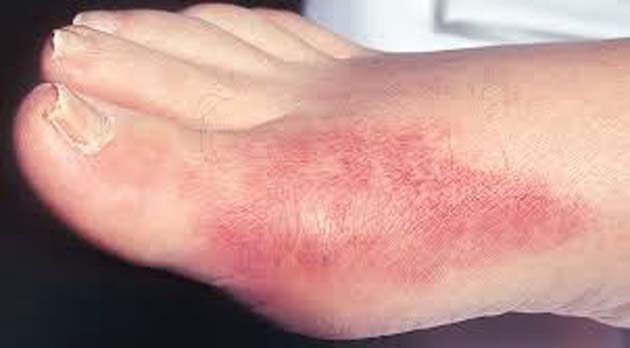 Llagas: en los pies pueden ser un síntoma de COVID-19