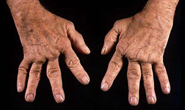 aji_artritis Distintos tipos de ají para las articulaciones
