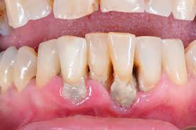 mascarilla_dientes Está provocando todo tipo de problemas dentales graves