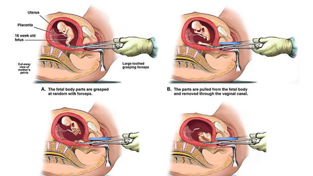 nebraska Prohibido interrumpir embarazo con un aborto por desmembramiento