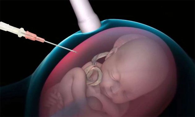 nebraska_prohibe Prohibido interrumpir embarazo con un aborto por desmembramiento