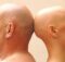 00 Tratamiento para la alopecia areata: caída cabello 00