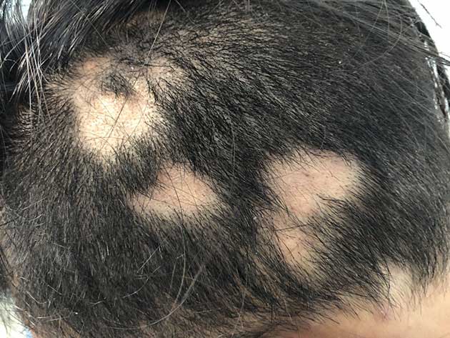 00 Cabello: hasta ahora 1700 personas sufren alopecía 00