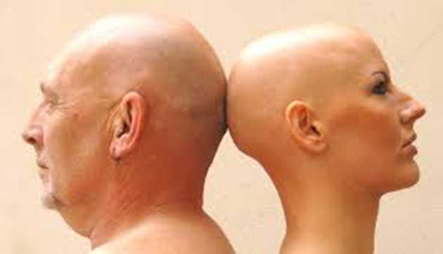 00  Cabello: hasta ahora 1700 personas sufren alopecía  00