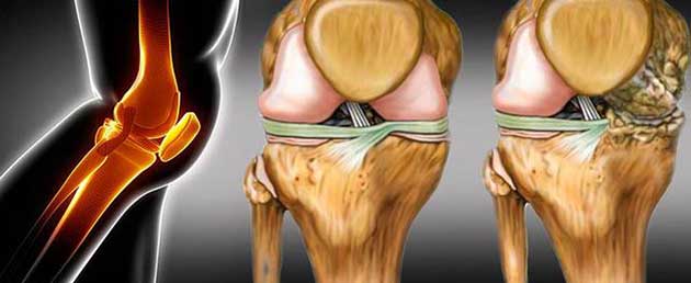 rodilla_lesion3 Desgaste de cartílago de la rodilla y desgarro de lesión slap