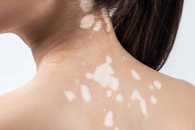 vitamina_vitiligo1 Optimizar la ingesta de vitamina D puede ayudar a tratar la psoriasis y el vitíligo