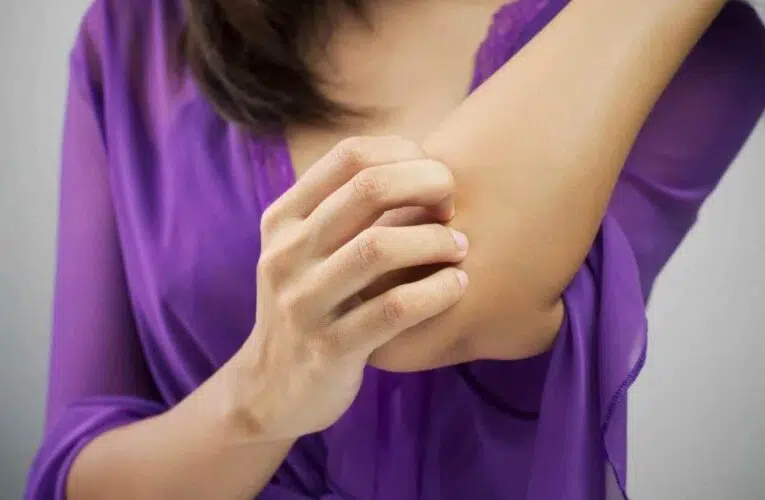 Eliminar ciertos alimentos de la dieta puede aliviar los síntomas del eczema