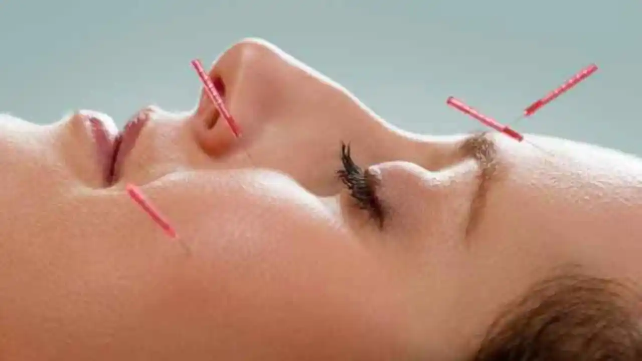 00 Beneficios de la acupuntura china para la salud 00
