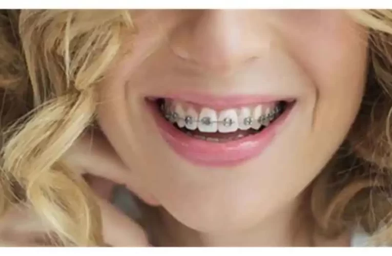 El riesgo de los aparatos ortopédicos (brackets)