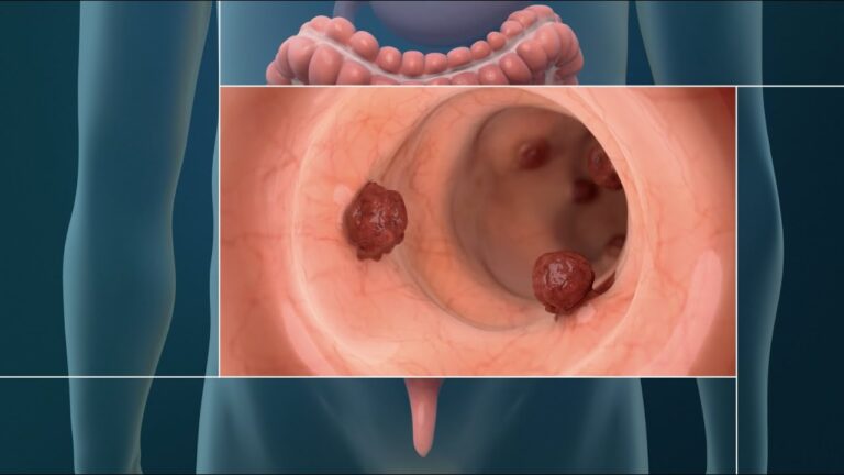 cancer-colorrectal-aumento-menores-de-50-anos - 2024-06-26 - Cancer Colorrectal