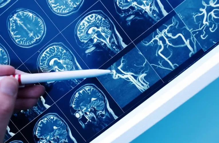 Epilepsia: Síntomas, Diagnóstico y Tratamientos Efectivos