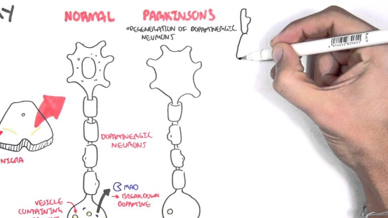 parkinson-sintomas-diagnostico-y-tratamientos - 2024-09-28 - Parkinson