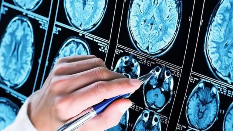 demencia-frontotemporal-sintomas-y-tratamientos - 2024-11-04 - Ela