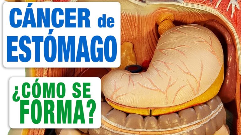 cancer-de-estomago-sintomas-y-tratamientos - 2024-11-29 - Cancer De Estomago
