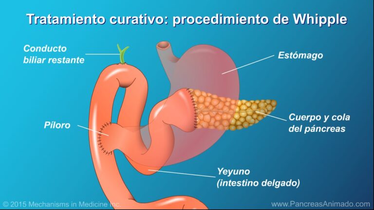 cancer-de-pancreas-sintomas-y-tratamientos - 2024-11-05 - Cancer De Pancreas
