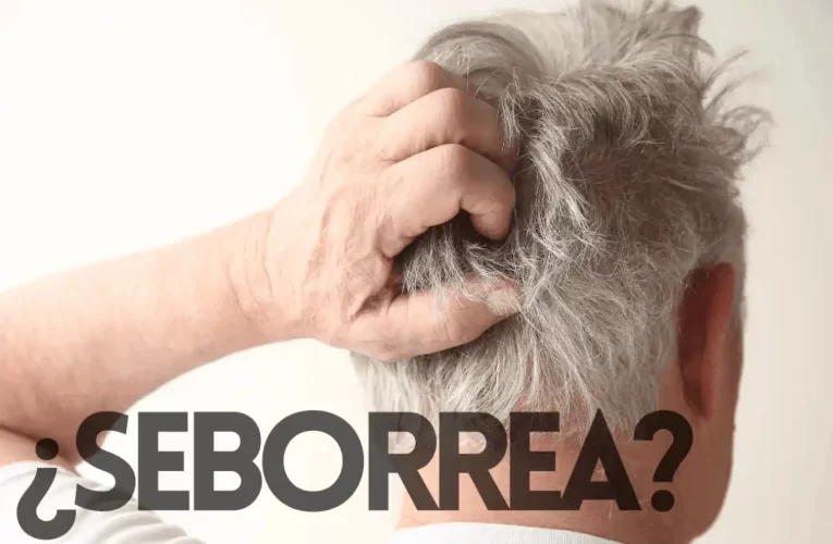 Todo lo que Necesitas Saber sobre la Seborrea: Causas, Síntomas y Tratamientos Efectivos