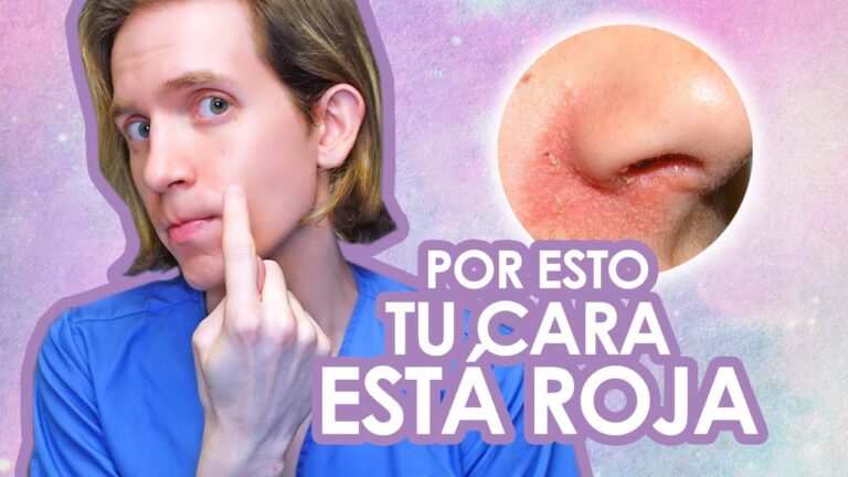 seborrea-causas-sintomas-y-tratamientos - 2025-03-03 - Seborrea