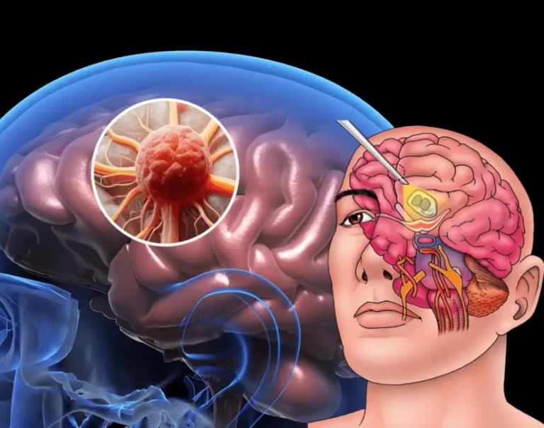 tumores-cerebrales-sintomas-y-diagnostico - 2025-02-21 - Tumores